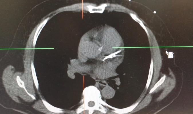 A calcium scoring CT scan showing a segment of heavily calcified coronary artery. 