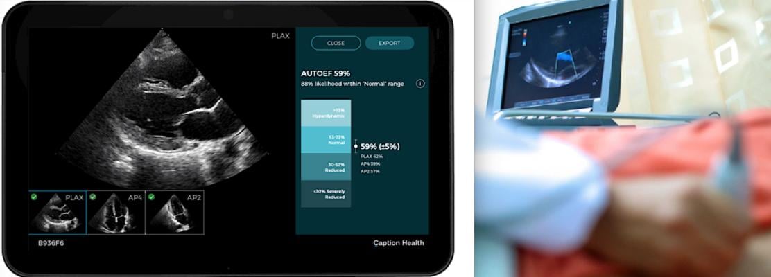 Caption Health's AI automated ejection fraction software.