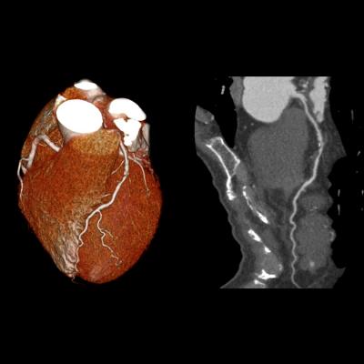 CTA, CT angiography, predict heart attacks, Radiology study