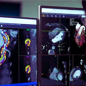 New Data Validates FAI-Score Biomarker, Highlights Potential Non-Contrast Cardiac CT Opportunity