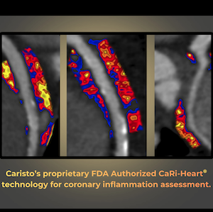 FDA Grants De Novo Authorization for Coronary Inflammation Quantification Technology