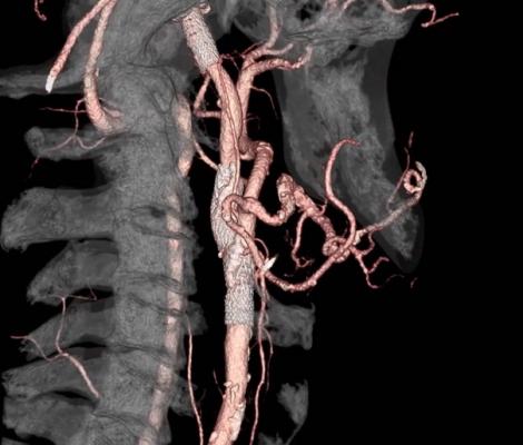 Newswise: New algorithm expands neurologists’ ability to assess for clot-removing procedure
