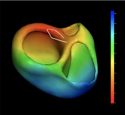 VIVO 3-D Cardiac Mapping System Cleared by FDA