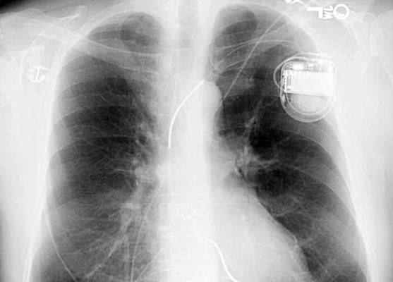 Artificial Intelligence Can Improve Emergency X-ray Identification of Pacemakers
