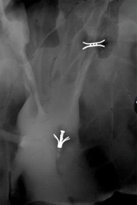 The ChordArt transcatheter mitral valve leaflet chord replacement system on X-ray, showing the anchoring sections of the artificial chord.
