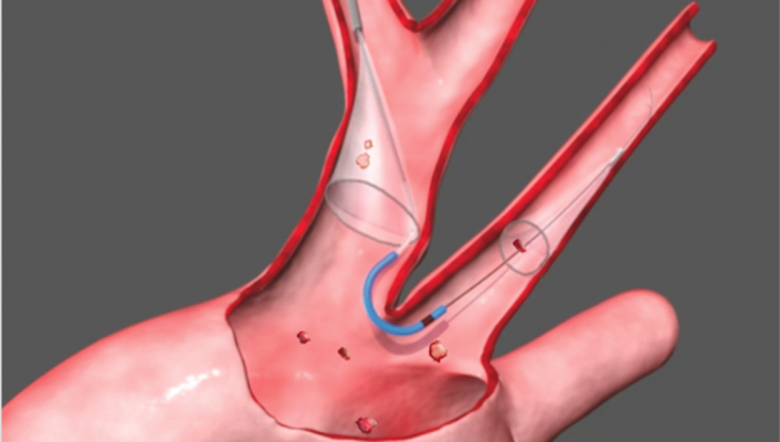 Claret's FDA-cleared Sentinel Cerebral Embolic Protection System for TAVR will expand Boston Scientific's structural heart portfolio. It collects emboli knocked loose that would otherwise lodge in the brain and potentially cause a stroke. 