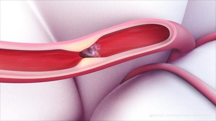 Delayed Clot Removal Still Improves Quality of Life Post-Stroke