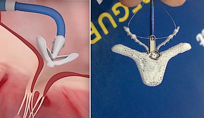 A comparison of the Edwards Pascal (left) and the Abbott MitraClip used for transcatheter mitral and tricuspid valve leaflet repairs. The two companies settled patent litigation regarding the devices today. 