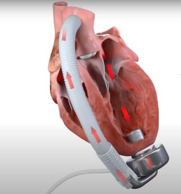 The CorWave LVAD uses a pulse pump rather than a rotary pump to move blood, so it more closely simulates the movement of blood in a read heart.
