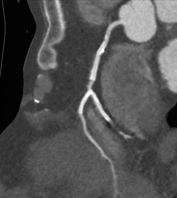 Double Kissing Crush Two-Stent Technique in Left Main Bifurcation Lesions Demonstrates Lower Target Lesion Failure Rates