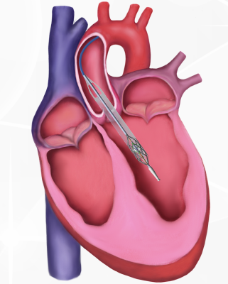 Magenta Medical, developer of the Elevate heart pump system, an FDA Designated Breakthrough Device, recently announced the completion of its FDA-approved Early Feasibility Study for the high-risk percutaneous coronary intervention (HR-PCI) indication. 