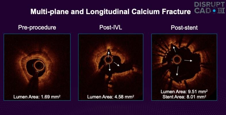 OCT imaging showing before and after images of a heavily calcified coronary artery treated using the Shockwave intravascular lithotripsy system. #TCT2021