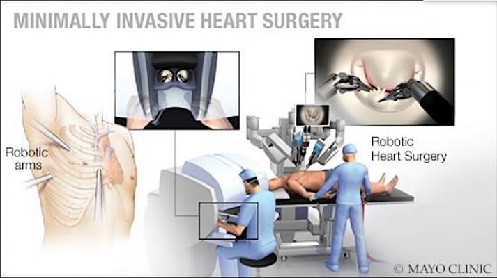Mayo Clinic uses the Da Vinci surgical robot to perform minimally invasive mitral valve surgeries. 