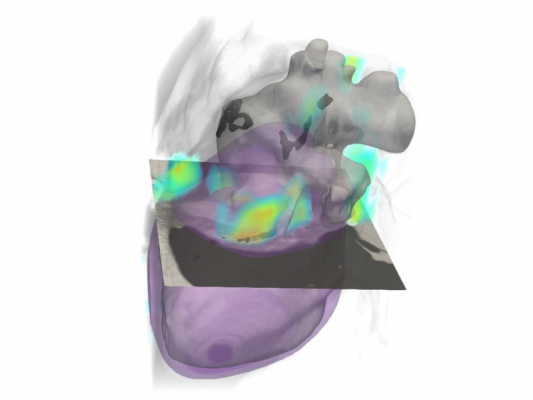 Rensselaer algorithm can identify risk of cardiovascular disease using lung cancer scan #CT