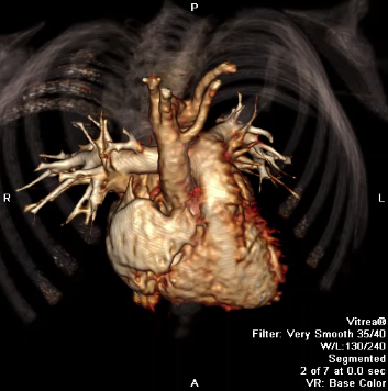 Cardiac CT image 3D reconstruction of the heart