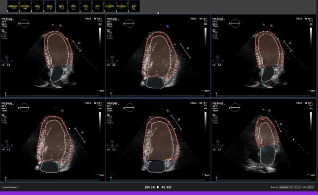 Libby’s AI and cloud-based technology aids Echocardiogram image analysis 