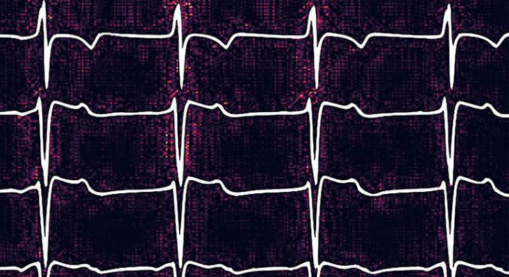  Pulmonary embolisms are dangerous, lung-clogging blot clots. In a pilot study, scientists at the Icahn School of Medicine at Mount Sinai showed for the first time that artificial intelligence (AI) algorithms can detect signs of these clots in electrocardiograms (EKGs), a finding which may one day help doctors with screening. 