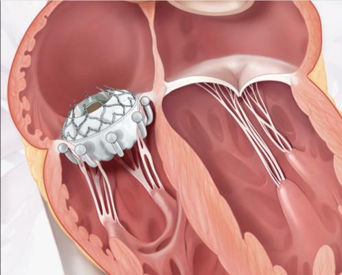 The Edwards Lifesciences Evoque transcatheter tricuspid valve replacement system demonstrated sustained favorable patient outcomes at six months in the TRISCEND study.