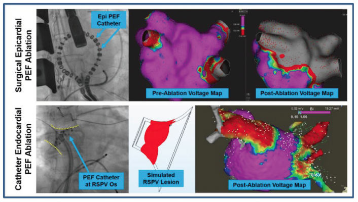 First-in-human Electroporation Ablation Study Finds Pulsed Electric Fields Can Target Specific Tissue For Atrial Fibrillation. #HRS2018 #HRS18