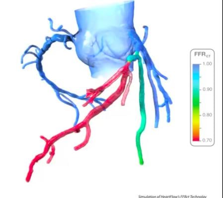 An example of HeartFlow's FFR-CT assessment, which shows areas of low blood flow based on computation fluid dynamics from a CT scan of the heart. The vendor's new PreRead software will use AI to clearly and reproducibly identify areas of ischemia due to coronary artery occlusion and act as a second set of eyes for emergency rooms evlautaing chest pain patients. 