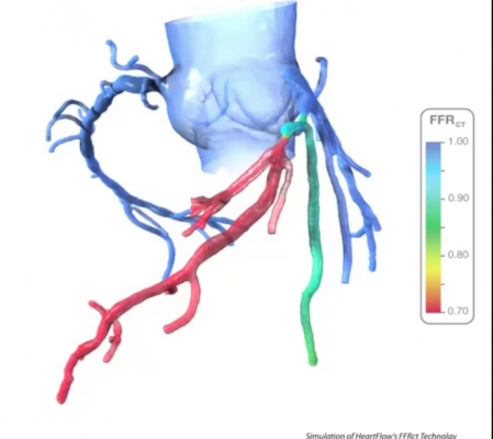 HeartFlow's FFR-CT (FFRct) analysis software can create a virtual FFR to assess coronary artery disease.