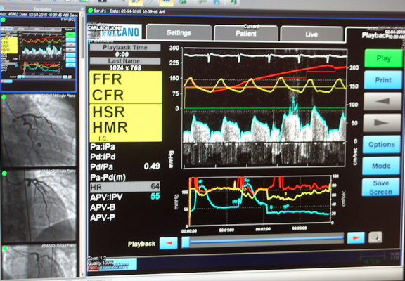 FFR software on the GE Centricity CVIS. A trial from the 2018 EuroPCR meeting showed FFR improves long-term outcomes.