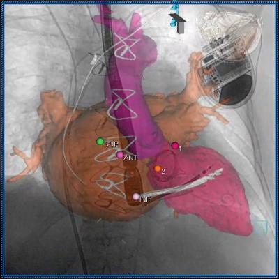 Figure 1: Segmentation performed on the left atrium, left ventricle and mitral bioprosthesis. Landmarks are placed on the site of optimal transseptal access into the left atrium and the mitral PVL.