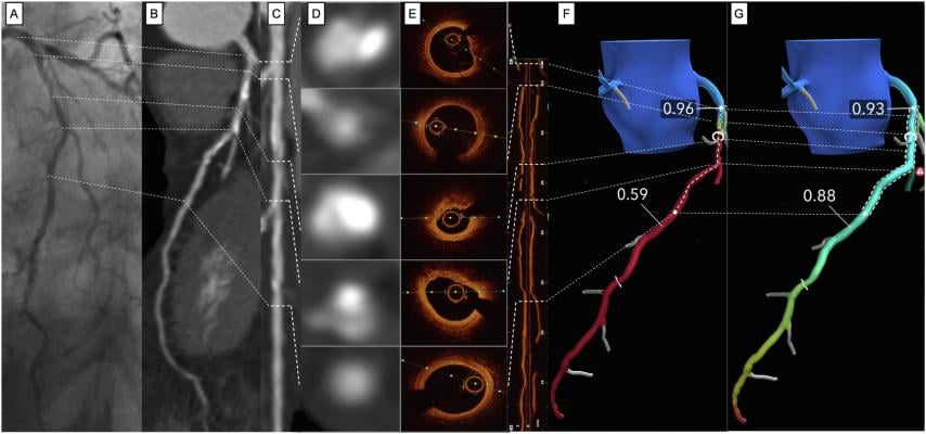 Image showing a co-registration of invasive coronary angiography (A), coronary CTA and straight MPR (panel B and C) with CTA cross sections (panel D), corresponding OCT cross sections and longitudinal OCT view (E).
