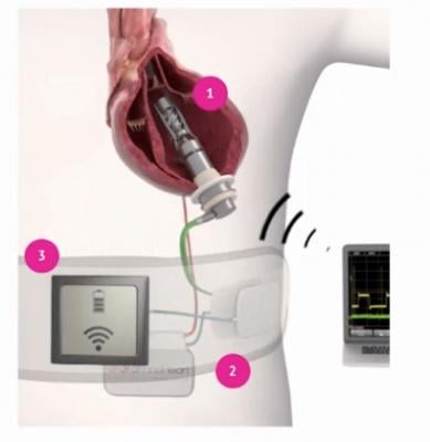 The FineHeart Transcutaneous Energy Transfer (TET) System for the ICOMS cardiac assist device. 1. The ICOMS heart pump. 2. The implanted TET transfer pad. 3. The external energy transfer pad.