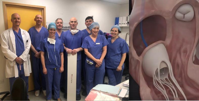 The heart team at St. James University Hospital Dublin was the first to perform a human implant of the CroiValve Duo Tricuspid Coaptation Valve technology for tricuspid repair.  