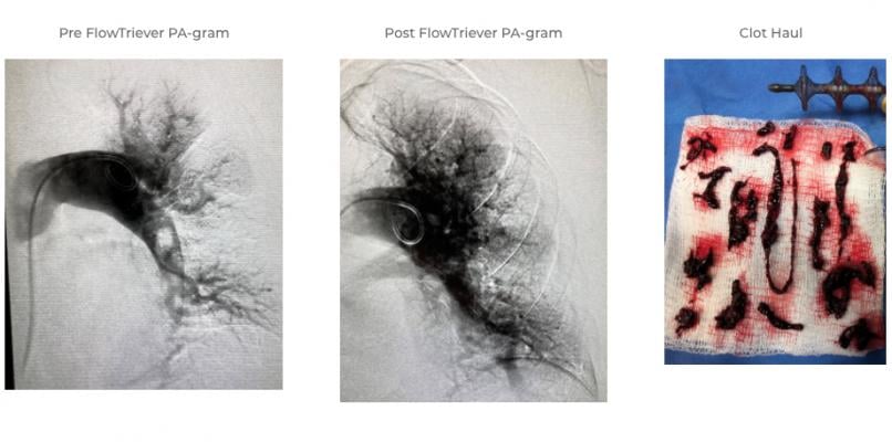 Patient case example of the FlowTriever thrombectomy device from Inari Medical Inc. in removing a pulmonary embolism and reporting blood flow and clot burden removed by the system. #TCT2020 #TCTconnect