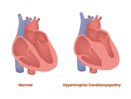 hypertrophic cardiomyopathy 