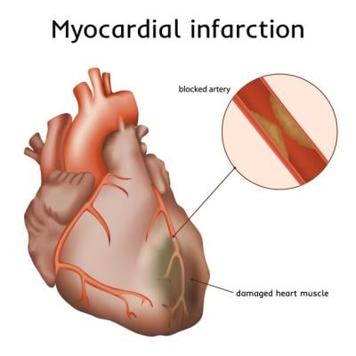 Recardio Inc., a late stage clinical-stage life science company developing regenerative therapies for cardiovascular diseases, announced that the FDA concurs with Recardio's pivotal Heal-MI Phase 3 trial design with Dutogliptin in Acute Myocardial Infarction