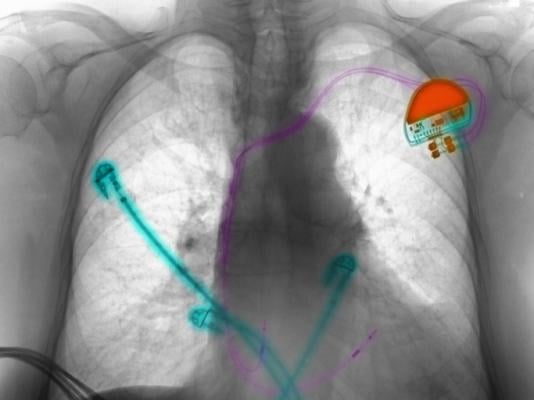 A heart-pacing lead is a small catheter with electrodes. 