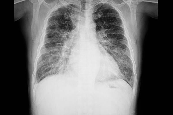 Chest X-ray of a congestive heart failure patient, showing fluid in the lower portions of the lungs and an enlarged heart. Getty Images
