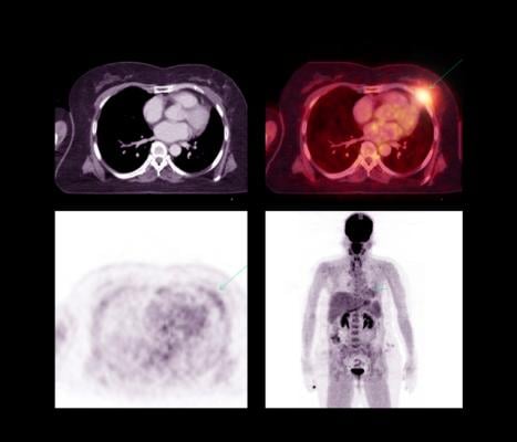 Radiation to the heart during treatment for locally advanced lung cancer is associated with an increased risk of major adverse cardiac events within the first two years following treatment. The higher the cardiac dose exposure, the higher the risk of a cardiac event.