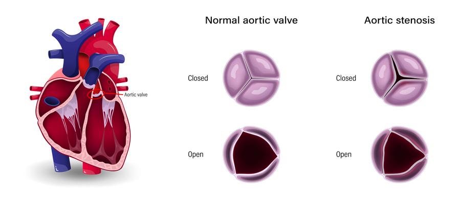 The diagnosed severity of aortic stenosis strongly correlates with clinical outcomes, new Kaiser Permanente research shows 