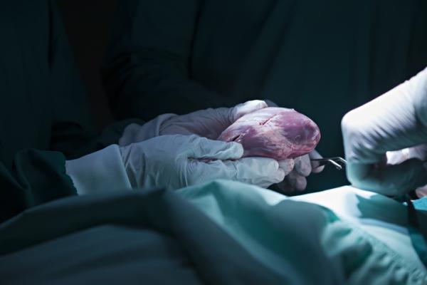 More donated hearts could be suitable for transplantation if they are kept functioning within the body for a short time following the death of the donor, new research has concluded.