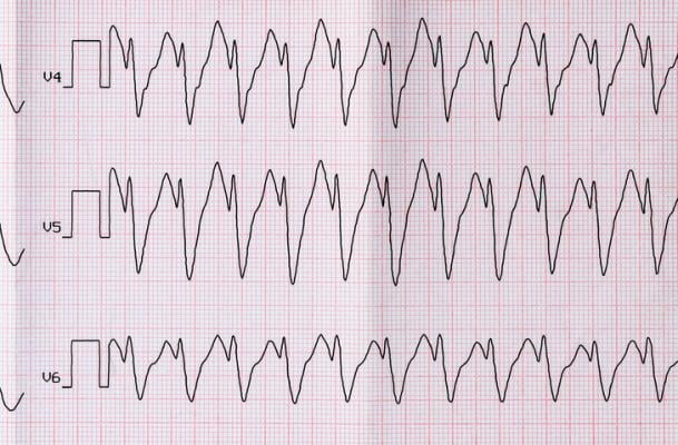 ECG with paroxysm correct form of atrial flutter. Getty Images