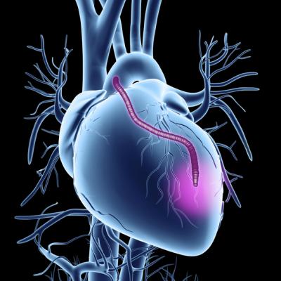 A new study presented at The Society of Thoracic Surgeons’ 2024 Annual Meeting in San Antonio, Texas, examines the ongoing controversy surrounding the choice between multi-arterial grafting (MAG) and single arterial grafting (SAG) in coronary artery bypass grafting (CABG) for multivessel coronary revascularization 