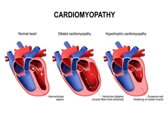 This is the first international guideline document to include all cardiomyopathy subtypes 