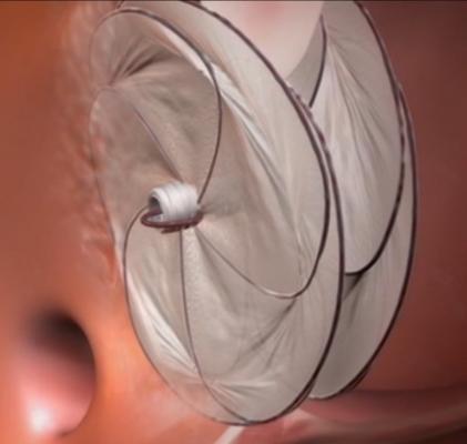 FDA Approves Gore Cardioform Septal Occluder for PFO Closure Prevent Recurrent Ischemic Stroke