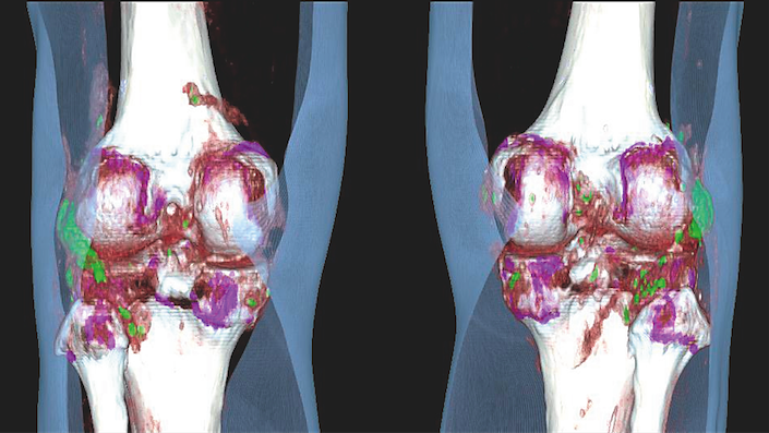 Trial for Gout Drug Meets Primary Endpoint, Raises Safety Concerns, image shows a CT scan showing gout in the knees.