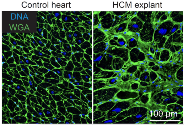 A microscopy picture of muscle cells in a normal heart (left) and muscle cells in a heart of a patient with hypertrophic cardiomyopathy (right). The black areas are single muscle cells. The muscle cells of the hypertrophic cardiomyopathy patient are bigger, and there is more space in between the cells (green), which is filled with scar tissues in the case of patients with hypertrophic cardiomyopathy. The blue indicates where the DNA of the cells can be found. Image courtesy of Anne de Leeuw, copyright Hubre