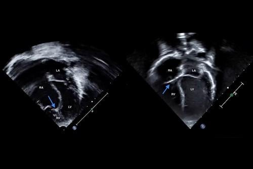 Left: Echocardiogram at birth shows severe non-delamination of the tricuspid valve septal leaflet, with coaptation point near the right ventricle apex (marked with arrow). The right ventricle is small, while the right atrium is large. Right: Jaxon’s echocardiogram today shows a normal tricuspid valve position (marked with arrow) and normal sizes of the right atrium and right ventricle. 