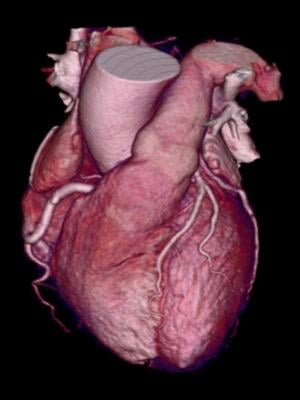 3-D rendering from a cardiac CT scan