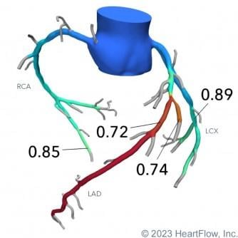 University Hospitals Harrington Heart & Vascular Institute first to adopt technology in U.S. 