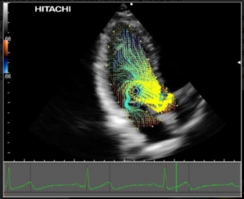 Hitachi, Vector Flow Mapping, TedMed 2016, Partho Sengupta, holographic evaluation of cardiac valves