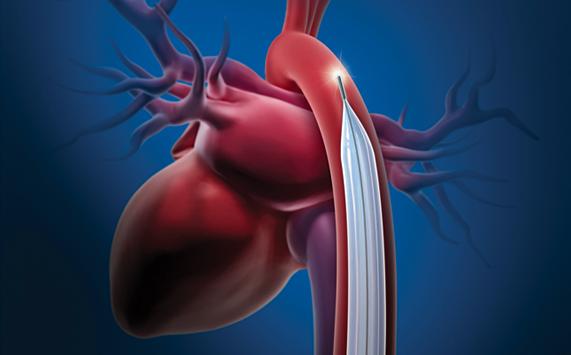 Cardiologists who have experience with COVID-19 patients in New York City say a low threshold should be used to assess patients for cardiogenic shock in the setting of acute systolic heart failure related to COVID-19. If inotropic support fails in these patients, researchers suggest use of an IABP (intra-aortic balloon pump) as the first line mechanical circulatory support device, because it requires the least maintenance from medical support staff. #coronavirus #COVID19 #SARScov2