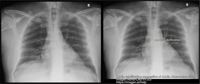 Designed to assist physicians detect findings on chest X-rays suggestive of Aortic Atherosclerosis and Aortic Ectasia.  